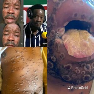 Monkeypox Awareness: Key Facts and Prevention Tips..see morre